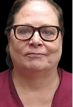 Laser Neck Lift and Submental Liposuction Before & After Patient #1328