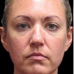 Laser Neck Lift and Submental Liposuction Before & After Patient #1335