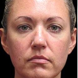 Laser Neck Lift and Submental Liposuction Before & After Patient #1335