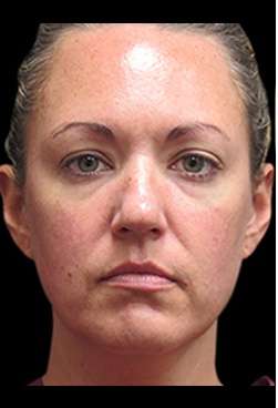 Laser Neck Lift and Submental Liposuction Before & After Patient #1335
