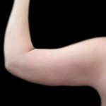 Arm Liposuction Before & After Patient #622