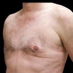 Liposuction and Gynecomastia Before & After Patient #775