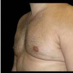 Liposuction and Gynecomastia Before & After Patient #786