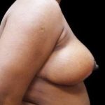 Liposuction and Breast Reduction Before & After Patient #627