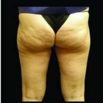 Female Liposuction Before & After Patient #805