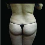 Female Liposuction Before & After Patient #813