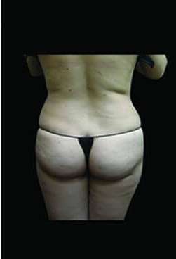 Female Liposuction Before & After Patient #813
