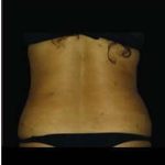 Female Liposuction Before & After Patient #818