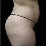 Female Liposuction Before & After Patient #825