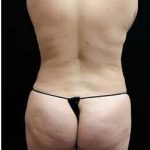 Female Liposuction Before & After Patient #834