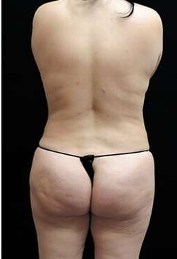 Female Liposuction Before & After Patient #834