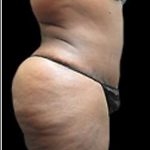 Female Liposuction Before & After Patient #863
