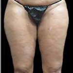 Female Liposuction Before & After Patient #868