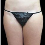 Female Liposuction Before & After Patient #877