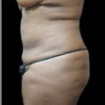 Female Liposuction Before & After Patient #887