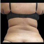 Female Liposuction Before & After Patient #899