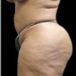 Female Liposuction Before & After Patient #908