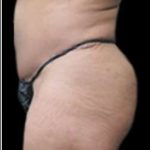 Female Liposuction Before & After Patient #915