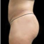 Female Liposuction Before & After Patient #923