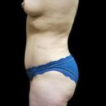 Female Liposuction Before & After Patient #930