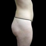 Female Liposuction Before & After Patient #939