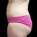 Female Liposuction Before & After Patient #948