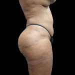 Female Liposuction Before & After Patient #960