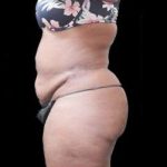Female Liposuction Before & After Patient #986