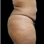 Female Liposuction Before & After Patient #995
