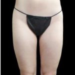 Female Liposuction Before & After Patient #1000