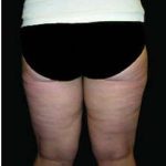Female Liposuction Before & After Patient #1019