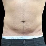 Male Liposuction Before & After Patient #1080