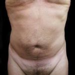 Male Liposuction Before & After Patient #1099