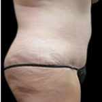 Liposuction and Mommy Makeover Before & After Patient #1112