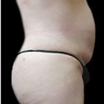 Liposuction and Mommy Makeover Before & After Patient #1133