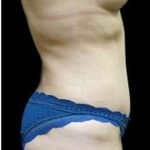Liposuction and Mommy Makeover Before & After Patient #1150