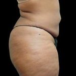 Liposuction and Mommy Makeover Before & After Patient #1157