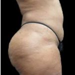 Liposuction and Mommy Makeover Before & After Patient #1177