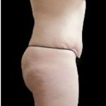 Liposuction and Mommy Makeover Before & After Patient #1186