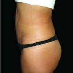 Liposuction and Mommy Makeover Before & After Patient #1193