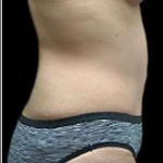 Liposuction and Mommy Makeover Before & After Patient #1218