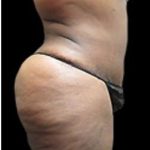 Liposuction and Mommy Makeover Before & After Patient #1231