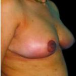 Liposuction and Breast Reduction Before & After Patient #672