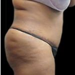 Liposuction and Mommy Makeover Before & After Patient #1240