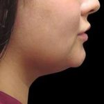 Laser Neck Lift and Submental Liposuction Before & After Patient #1258