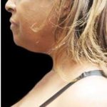 Laser Neck Lift and Submental Liposuction Before & After Patient #1265