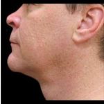 Laser Neck Lift and Submental Liposuction Before & After Patient #1272