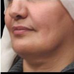 Laser Neck Lift and Submental Liposuction Before & After Patient #1279