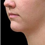 Laser Neck Lift and Submental Liposuction Before & After Patient #1286