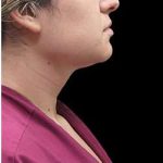 Laser Neck Lift and Submental Liposuction Before & After Patient #1297